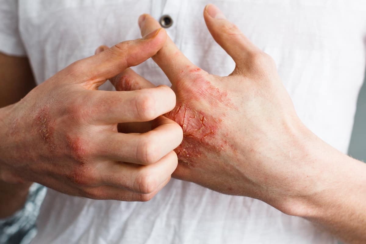 cbd oil for eczema 1