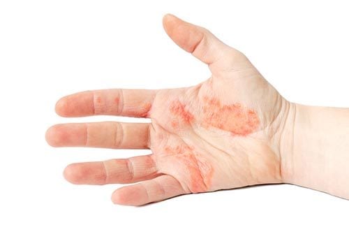 eczema hand with flare up of symptoms redness and red patches 500x332 1